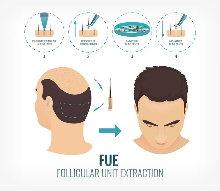 DHI Hair Transplant