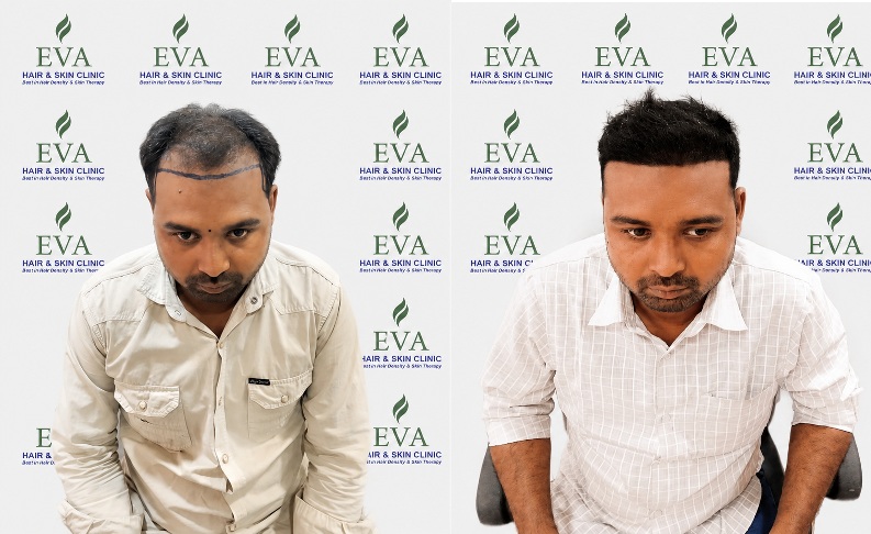 Hair Fall & Hair Loss Treatment