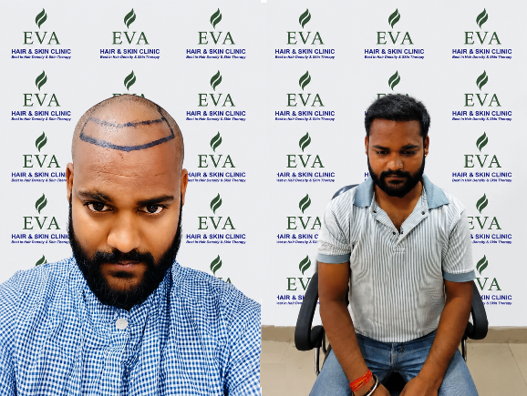 Hair transplant result