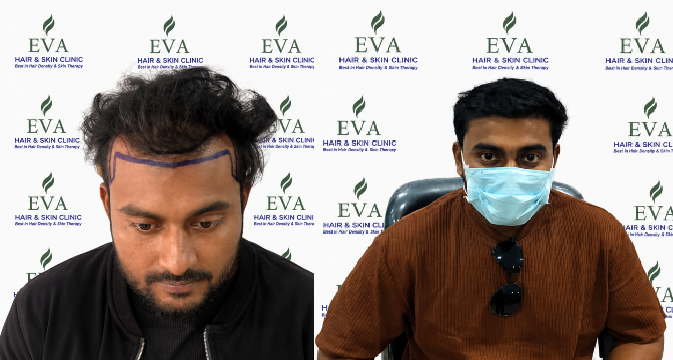 Hair transplant result