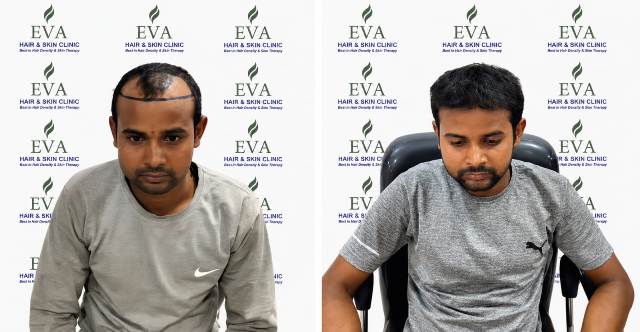 Beard & Eyebrow Restoration